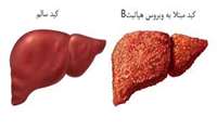 علائم هپاتیت و راه‌های انتقال ویروس آن را بشناسید